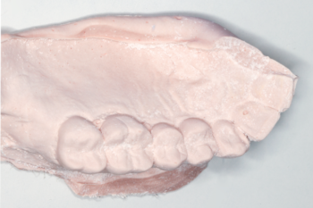 Preop Study Model for Impression