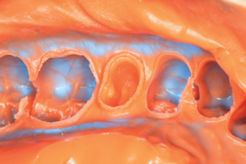 Fig. 9 Detailed view of the lingual and mesial margins