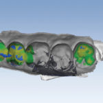 Heat map of a dental bite.