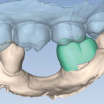 Plan with dental bite in place.