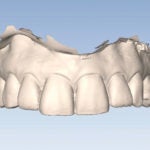 Full-arch dental models.
