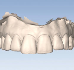 Full-arch dental models.