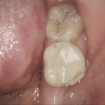 Intraoral Cameras - A Picture is Worth 1000 Words