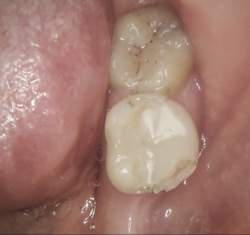 Intraoral Cameras - A Picture is Worth 1000 Words