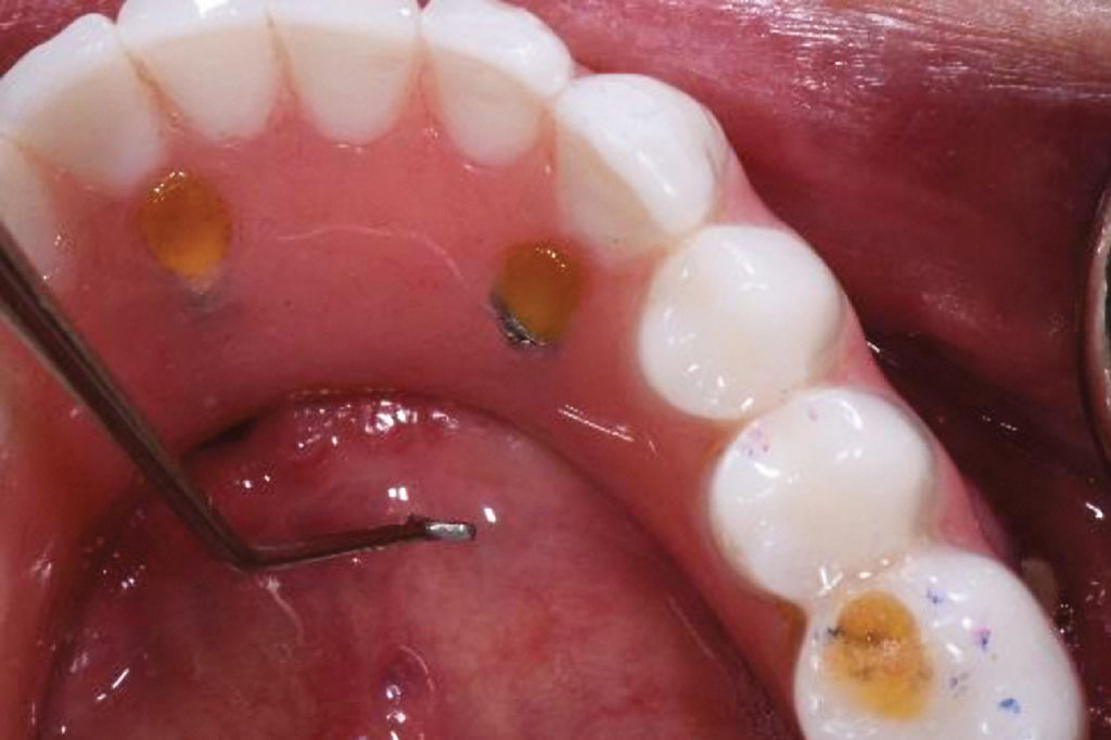 Fig. 11 Observe the location of the screw access hole on the prosthesis; lining up the instrument will allow for discovery underlying components. 