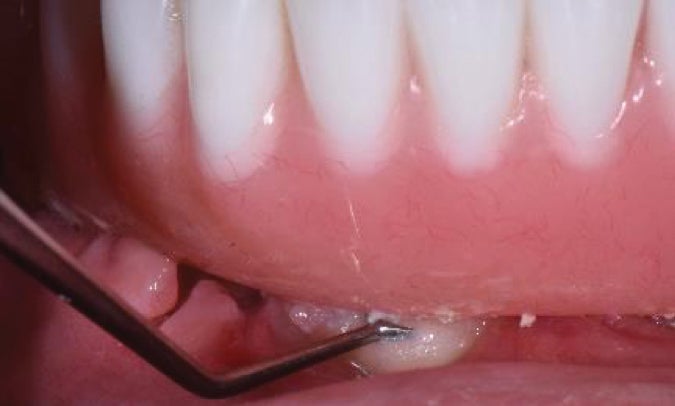 Fig. 9 Pineyro Ti1 is being used to displace the tissues painlessly to gain access between prosthesis and gingiva notice the blanching of the soft tissue.