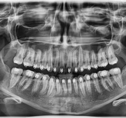 Cone Beam CT: How to Read Scans Like Pans