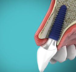 Minimally Traumatic Extractions and Implant Therapy (Hands-On Course) 1