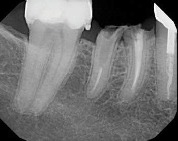 Recurrent decay revealed clinically