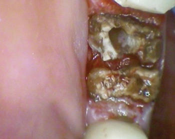 Fig 2. Decay visible after crown removal