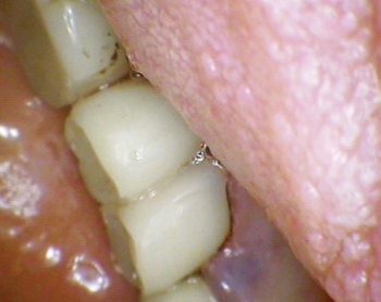 Fig 3. After cleaning tissue and removing caries