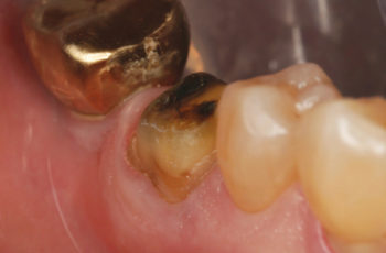 Final preparation of tooth No. 30