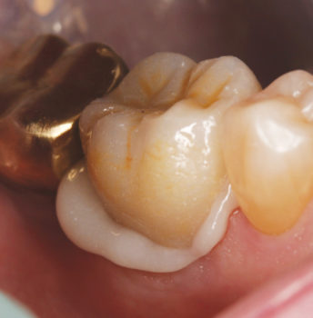 Zirconia crown No. 30