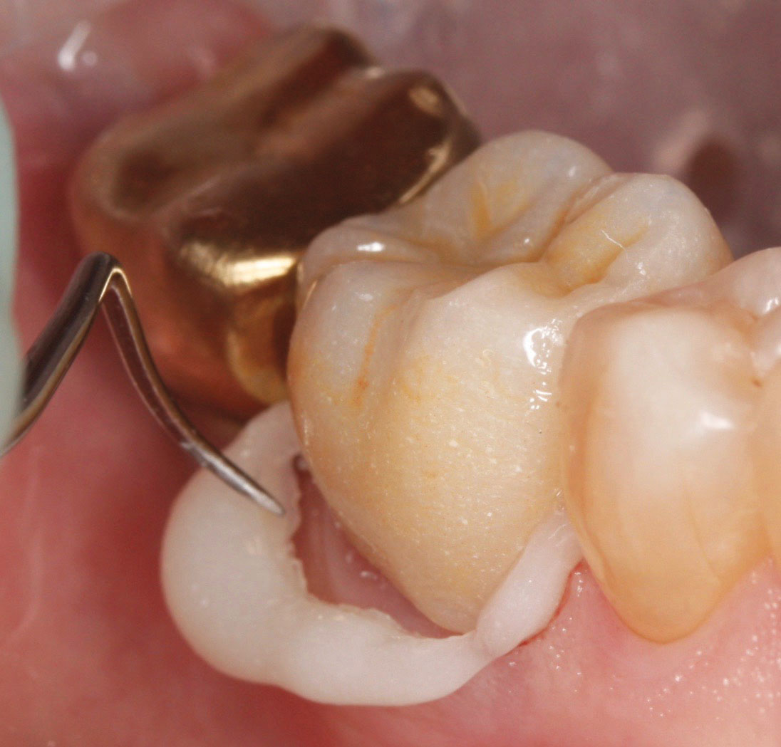 SelfAdhesive Resin ZRCem™ Burkhart Dental Supply