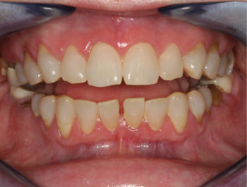 1A - Spacing between lower incisors contributing to difficulty eating