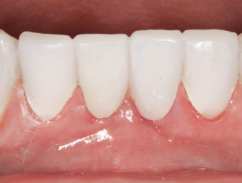 1F – 45-day high post-operative image shows high polish and precise adaptation around tissues.