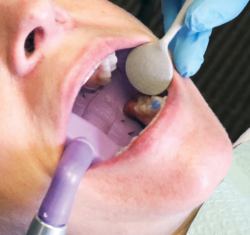 Mr. Thirsty in use on Patient