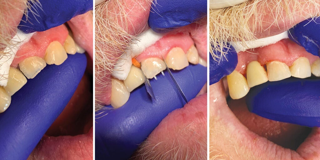New Dental Glass Pin Transforms Tooth Repair 3
