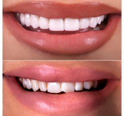Intelligent Simplification of Anterior Composites (4 Credits)