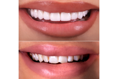 Intelligent Simplification of Anterior Composites (4 Credits)